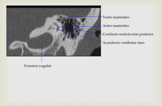 Techo mastoideo
Antro mastoideo
Conducto semicircular posterior
Acueducto vestibular óseo
Foramen yugular
 