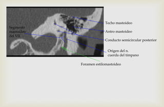 Techo mastoideo
Antro mastoideo
Conducto semicircular posterior
Segmento
mastoideo
del VII
Foramen estilomastoideo
Origen del n.
cuerda del tímpano
 