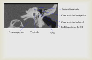 Eminendia arcuata
Canal semicircular superior
Vestíbulo
Canal semicircular lateral
Rodilla posterior del VII
CAEForamen yugular
 