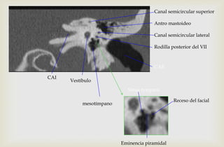 Canal semicircular superior
Antro mastoideo
Canal semicircular lateral
Rodilla posterior del VII
Vestíbulo
CAE
CAI
mesotímpano
Receso del facial
Eminencia piramidal
Sinus tympani
 
