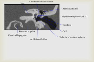 Apófisis estiloides
Canal del hipogloso
Foramen yugular
CAI
Canal semicircular lateral
Vestíbulo
Nicho de la ventana redonda
Segmento timpánico del VII
CAE
Antro mastoideo
 