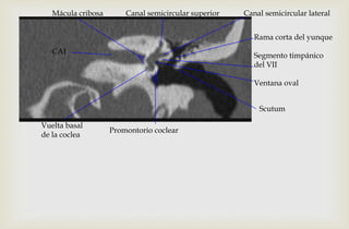 Canal semicircular superior Canal semicircular lateralMácula cribosa
Rama corta del yunque
Segmento timpánico
del VII
Ventana oval
Promontorio coclear
Scutum
Vuelta basal
de la coclea
CAI
 