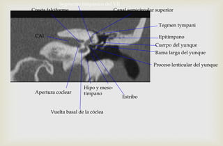 Cresta falciforme
Apertura coclear
Hipo y meso-
tímpano
Vuelta basal de la cóclea
Tegmen tympani
Epitímpano
Canal semicircular superior
Cuerpo del yunque
Rama larga del yunque
Proceso lenticular del yunque
Estribo
Segmento timpánico del VII
CAI
 