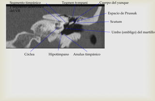 Cuerpo del yunque
Umbo (ombligo) del martillo
Scutum
Espacio de Prussak
Tegmen tympani
Hipotímpano Anulus timpánicoCóclea
Segmento timpánico
y segmento laberíntico
del VII
 