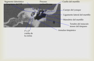 Segmento laberíntico
y timpánico del VII
1ª y 2ª
vuelta de
la cóclea
Annulus timpánico
Cuerpo del yunque
Ligamento lateral del martillo
Manubrio del martillo
Cuello del martilloProceso
cocleariforme
Tendón del músculo
tensor del tímpano
 