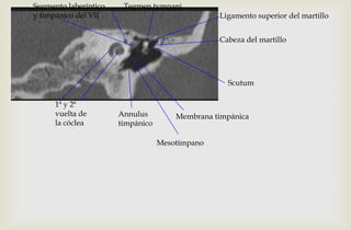 Cabeza del martillo
Tegmen tympani
Scutum
Annulus
timpánico
1ª y 2ª
vuelta de
la cóclea
Segmento laberíntico
y timpánico del VII
Membrana timpánica
Mesotímpano
Ligamento superior del martillo
 