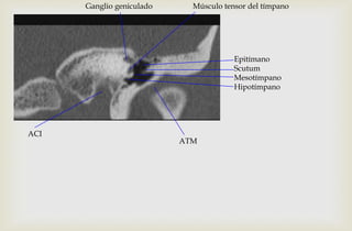 Ganglio geniculado Músculo tensor del tímpano
ACI
ATM
Epitímano
Scutum
Mesotímpano
Hipotímpano
 