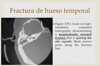 
Fractura de hueso temporal
 Figure 139.3 Axial cut high-
resolution computed
tomography demonstrating
a longitudinally oriented
fracture that is sparing the
otic capsule. Black arrows
point along the fracture
line.
 