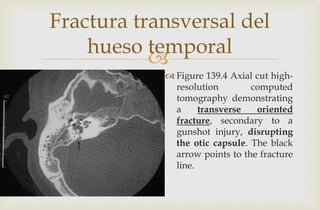 
Fractura transversal del
hueso temporal
 Figure 139.4 Axial cut high-
resolution computed
tomography demonstrating
a transverse oriented
fracture, secondary to a
gunshot injury, disrupting
the otic capsule. The black
arrow points to the fracture
line.
 