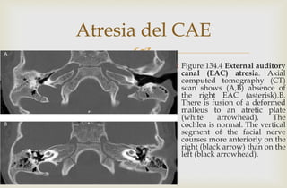 
Atresia del CAE
 Figure 134.4 External auditory
canal (EAC) atresia. Axial
computed tomography (CT)
scan shows (A,B) absence of
the right EAC (asterisk).B.
There is fusion of a deformed
malleus to an atretic plate
(white arrowhead). The
cochlea is normal. The vertical
segment of the facial nerve
courses more anteriorly on the
right (black arrow) than on the
left (black arrowhead).
 