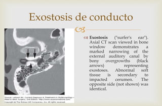
Exostosis de conducto
 Exostosis ("surfer's ear").
Axial CT scan viewed in bone
window demonstrates a
marked narrowing of the
external auditory canal by
bony overgrowths (black
arrows) representing
exostoses. Abnormal soft
tissue is secondary to
impacted cerumen. The
opposite side (not shown) was
identical.
 
