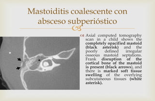 
Mastoiditis coalescente con
absceso subperióstico
 Axial computed tomography
scan in a child shows the
completely opacified mastoid
(black asterisk) and the
poorly defined irregular
osseous mastoid septations.
Frank disruption of the
cortical bone of the mastoid
is present (black arrows), and
there is marked soft tissue
swelling of the overlying
subcutaneous tissues (white
asterisk).
 