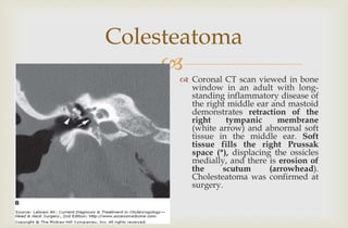 
Colesteatoma
 Coronal CT scan viewed in bone
window in an adult with long-
standing inflammatory disease of
the right middle ear and mastoid
demonstrates retraction of the
right tympanic membrane
(white arrow) and abnormal soft
tissue in the middle ear. Soft
tissue fills the right Prussak
space (*), displacing the ossicles
medially, and there is erosion of
the scutum (arrowhead).
Cholesteatoma was confirmed at
surgery.
 
