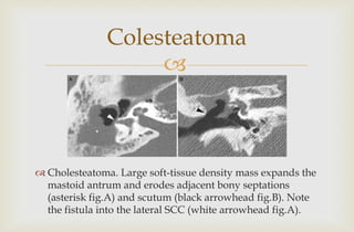 
Colesteatoma
 Cholesteatoma. Large soft-tissue density mass expands the
mastoid antrum and erodes adjacent bony septations
(asterisk fig.A) and scutum (black arrowhead fig.B). Note
the fistula into the lateral SCC (white arrowhead fig.A).
 