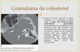 
Granuloma de colesterol
 Axial CT scan viewed in bone
window in a different patient
with a large left petrous apex
cholesterol granuloma
demonstrates an expansile lesion
(arrows) that has eroded and
remodeled the left petrous apex
as well as parts of the adjacent
clivus and otic capsule. The
internal auditory canal (black
arrowhead) has been partly
eroded. Note the normal right
petrous apex (PA) for
comparison.
 