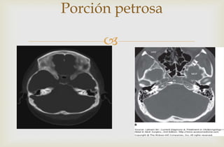 
Porción petrosa
 
