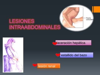 LESIONES
INTRAABDOMINALES


                        laceración hepática.


                           estallido del bazo


         lesión renal
 