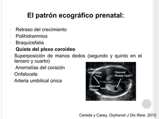 El patrón ecográfico prenatal: 
 Retraso del crecimiento 
 Polihidramnios 
 Braquicefalia 
 Quiste del plexo coroideo 
 Superposición de manos dedos (segundo y quinto en el 
tercero y cuarto) 
 Anomalías del corazón 
 Onfalocele 
 Arteria umbilical única 
Cereda y Carey, Orphanet J Dis Rare. 2012 
 