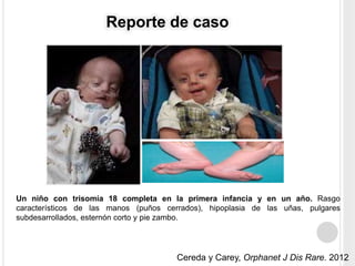 Reporte de caso 
Un niño con trisomía 18 completa en la primera infancia y en un año. Rasgo 
característicos de las manos (puños cerrados), hipoplasia de las uñas, pulgares 
subdesarrollados, esternón corto y pie zambo. 
Cereda y Carey, Orphanet J Dis Rare. 2012 
 