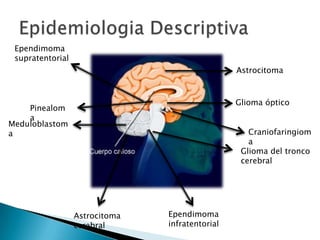 Ependimoma
 supratentorial
                                                 Astrocitoma



                                                 Glioma óptico
    Pinealom
    a
Meduloblastom
a                                                   Craniofaringiom
                                                    a
                                                  Glioma del tronco
                                                  cerebral




                  Astrocitoma   Ependimoma
                  cerebral      infratentorial
 