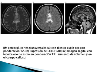 RM cerebral, cortes transversales (a) con técnica espín eco con
ponderación T2. (b) Supresión de LCR (FLAIR) (c) Imagen sagital con
técnica eco de espín en ponderación T1: aumento de volumen y en
el cuerpo calloso.
 