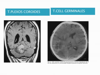 T.PLEXOS COROIDES   T.CELL GERMINALES
 