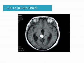 T. DE LA REGION PINEAL
 