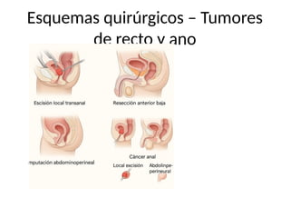 Esquemas quirúrgicos – Tumores
de recto y ano
 