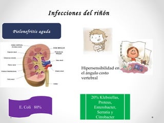 Pielonefritis aguda
Infecciones del riñón
Hipersensibilidad en
el ángulo costo
vertebral
E. Coli 80%
20% Klebsiellas,
Proteus,
Enterobacter,
Serratia y
Citrobacter
 