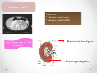 Abscesos renales
Pueden ser:
 Abscesos perirrenales
 Abscesos pararrenales
Pueden ser:
 Abscesos perirrenales
 Abscesos pararrenales
Mas comunes por E. Coli
Y Proteus
Diseminación hematógena
Bacterias gramnegativas
 