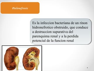 Es la infeccion bacteriana de un rinon
hidronefrotico obstruido, que conduce
a destruccion supurativa del
parenquima renal y a la perdida
potencial de la funcion renal
Es la infeccion bacteriana de un rinon
hidronefrotico obstruido, que conduce
a destruccion supurativa del
parenquima renal y a la perdida
potencial de la funcion renal
Pielonefrosis
 