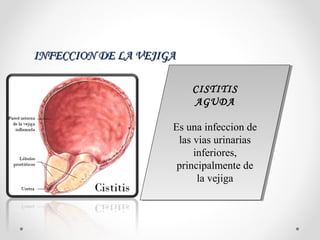 INFECCION DE LA VEJIGAINFECCION DE LA VEJIGA
CISTITIS
AGUDA
Es una infeccion de
las vias urinarias
inferiores,
principalmente de
la vejiga
CISTITIS
AGUDA
Es una infeccion de
las vias urinarias
inferiores,
principalmente de
la vejiga
 