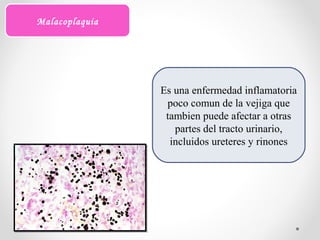 Es una enfermedad inflamatoria
poco comun de la vejiga que
tambien puede afectar a otras
partes del tracto urinario,
incluidos ureteres y rinones
Malacoplaquia
 