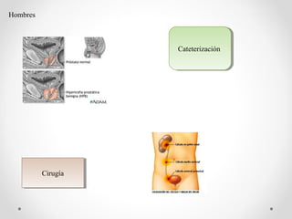 Hombres
CateterizaciónCateterización
CirugíaCirugía
 