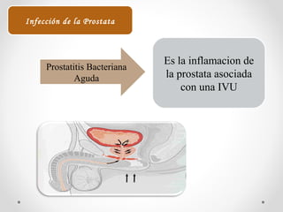 Prostatitis Bacteriana
Aguda
Es la inflamacion de
la prostata asociada
con una IVU
Infección de la Prostata
 