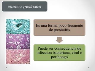Prostatitis Granulomatosa
 