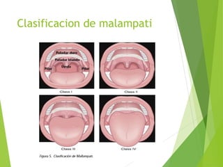 Clasificacion de malampati
 