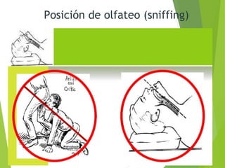 Posición de olfateo (sniffing)
 
