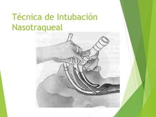 Técnica de Intubación
Nasotraqueal
 