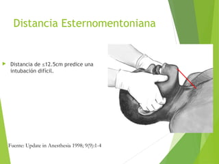 Distancia Esternomentoniana
 Distancia de ≤12.5cm predice una
intubación difícil.
Fuente: Update in Anesthesia 1998; 9(9):1-4
 