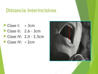 Distancia Interincisivos
 Clase I: > 3cm
 Clase II: 2.6 - 3cm
 Clase IV: 2.0 - 2.5cm
 Clase IV: < 2cm
 