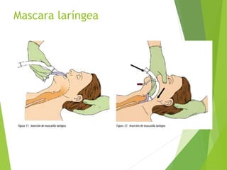 Mascara laríngea
 