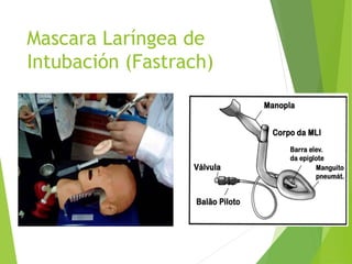 Mascara Laríngea de
Intubación (Fastrach)
 