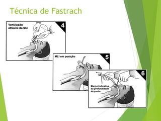 Técnica de Fastrach
 