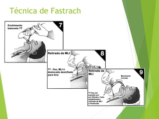 Técnica de Fastrach
 