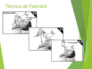 Técnica de Fastrach
 