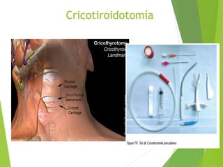Cricotiroidotomía
 