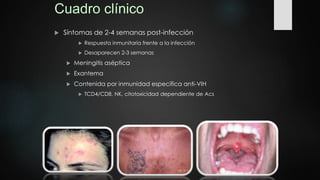 Cuadro clínico
 Síntomas de 2-4 semanas post-infección
 Respuesta inmunitaria frente a la infección
 Desaparecen 2-3 semanas
 Meningitis aséptica
 Exantema
 Contenida por inmunidad específica anti-VIH
 TCD4/CD8, NK, citotoxicidad dependiente de Acs
 