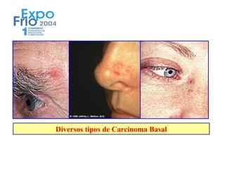 Diversos tipos de Carcinoma Basal
 