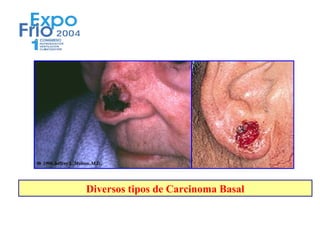 Diversos tipos de Carcinoma Basal
 